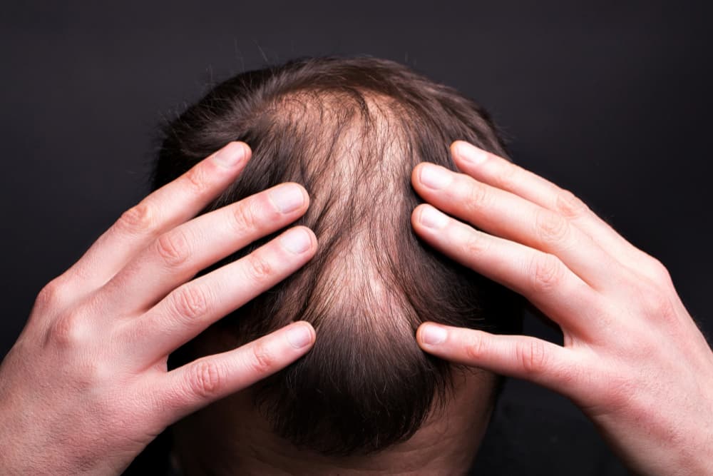 Efectos secundarios trasplante de cabello