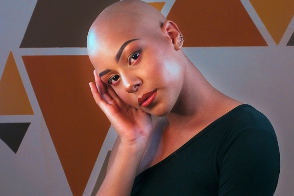 ¿Qué tipos de alopecia femenina existen?