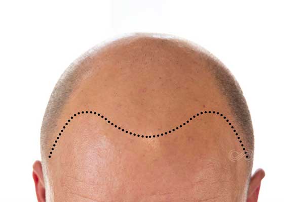 Bajar-linea-de-cabello con trasplante capilar